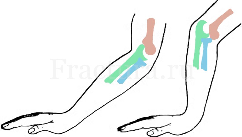 Переломы костей предплечья.
