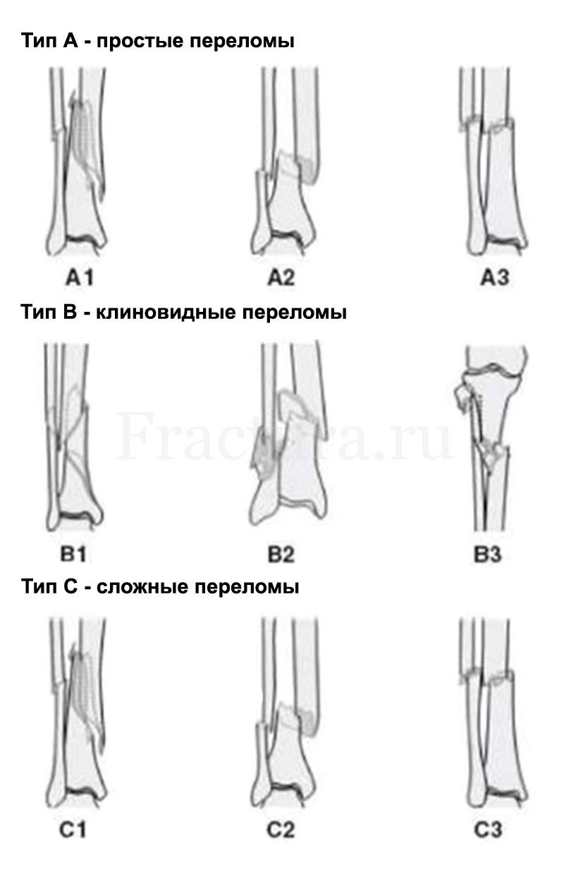 Перелом голени картинки